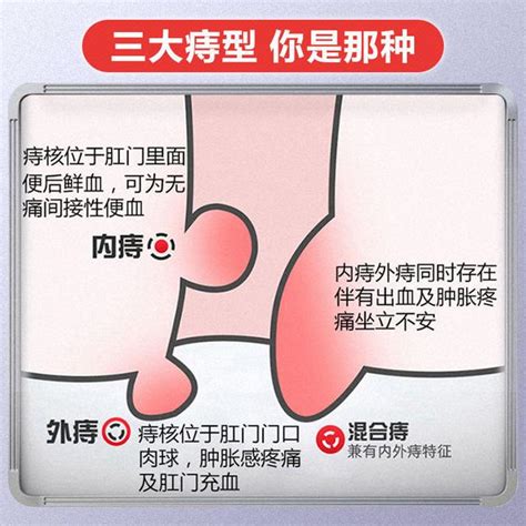 內外痣|痔瘡治療方式怎麼選？外痔與內痔的症狀、治療、術後。